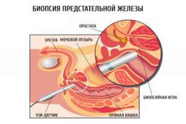 Биопсия простаты
