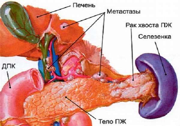 метастазирование рака