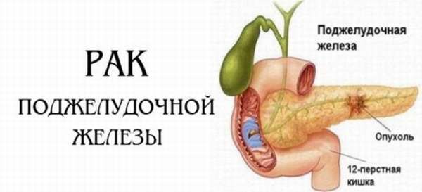 Что такое рак поджелудочной железы?