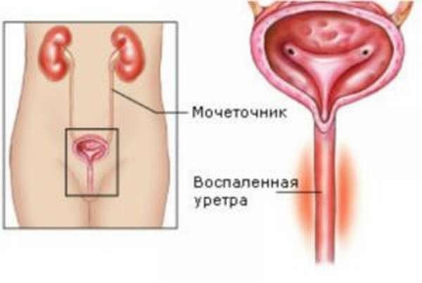 Уретрит