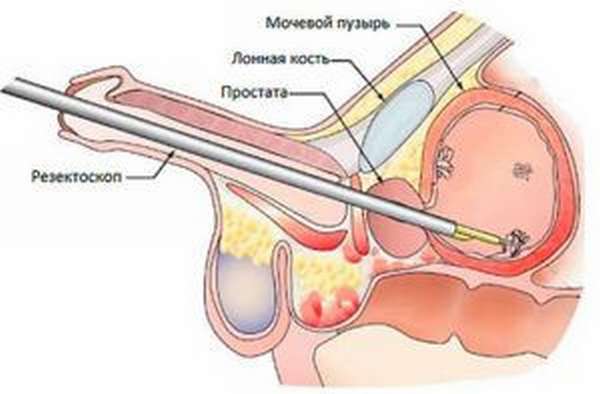 Резекция