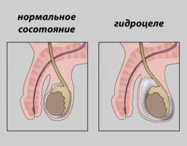 Варикоцеле может спровоцировать развитие гидроцеле