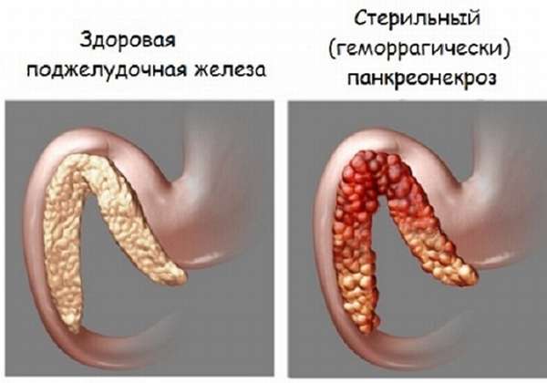 Геморрагический панкреонекроз