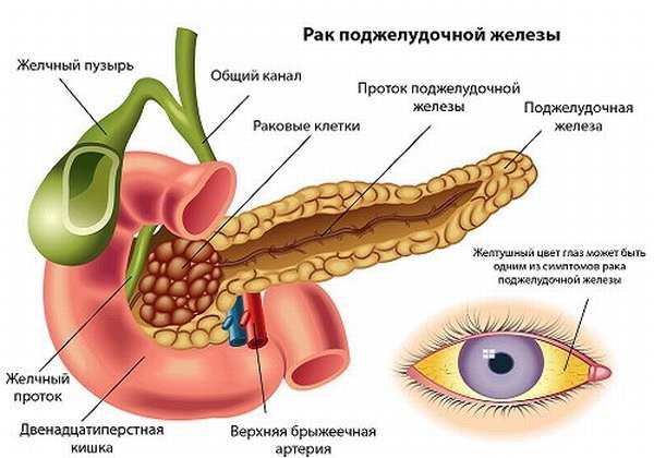 Симптоматика рака ПЖ