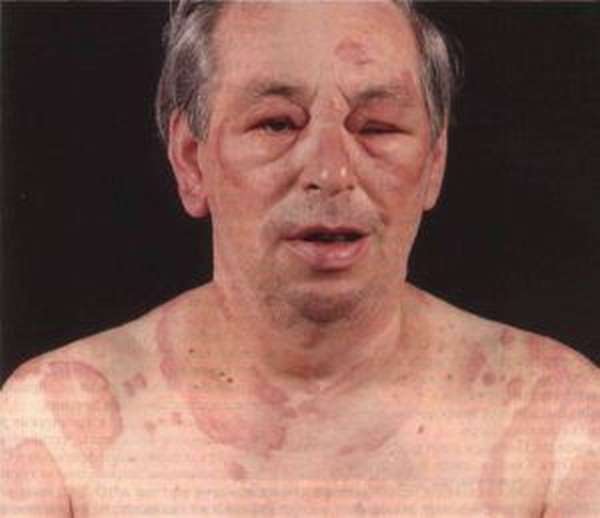 Отек Квинке