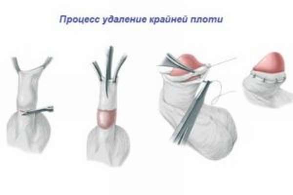 Обрезание