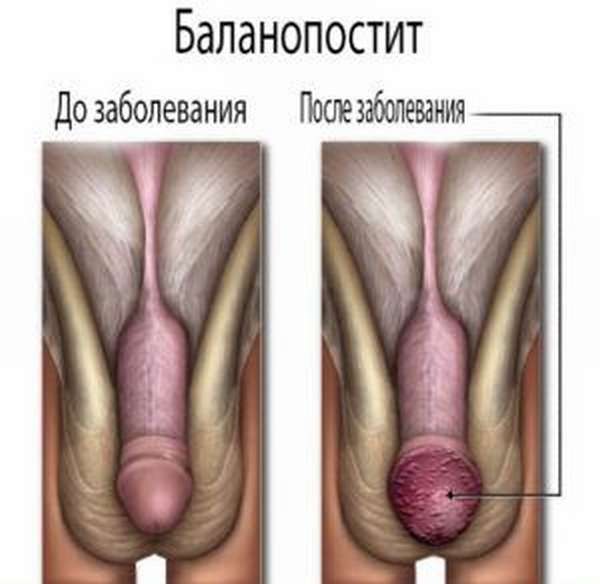 баланопостит