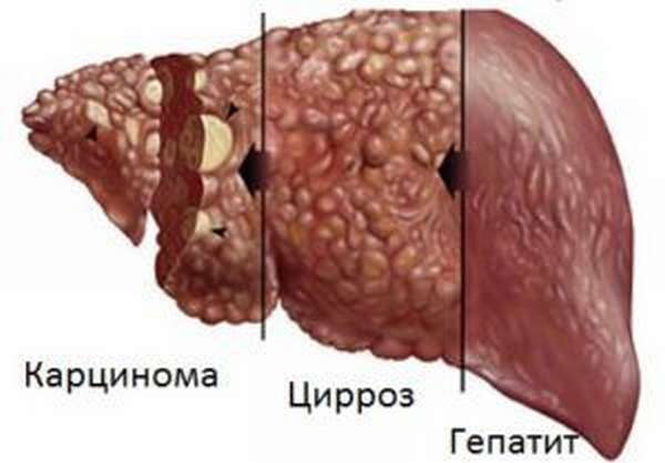 Поражение печени