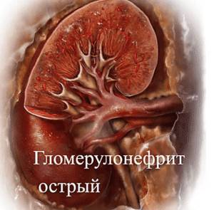 Гломерулонефрит
