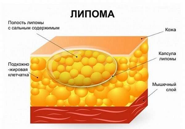 Липома ПЖ