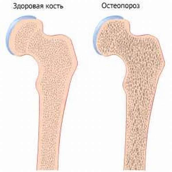 Избыток фосфора провоцирует остеопороз