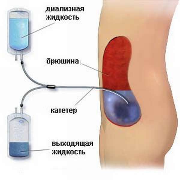 Перитонеальный диализ