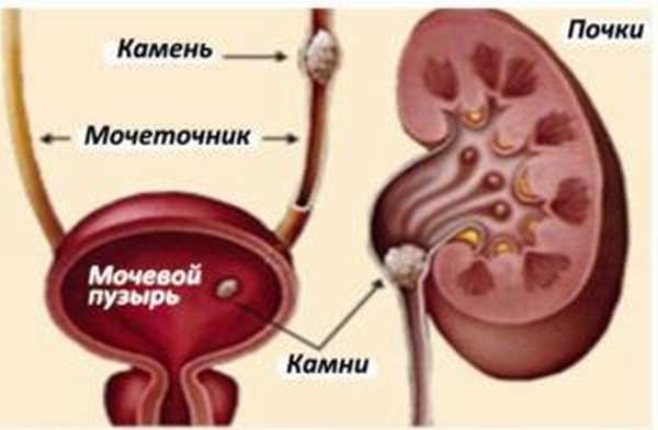 Как вывести камень из мочеточника