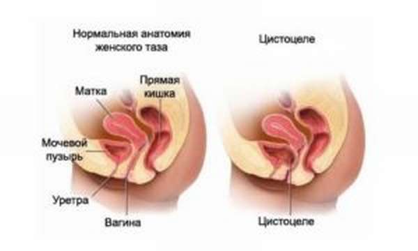 Цистоцеле