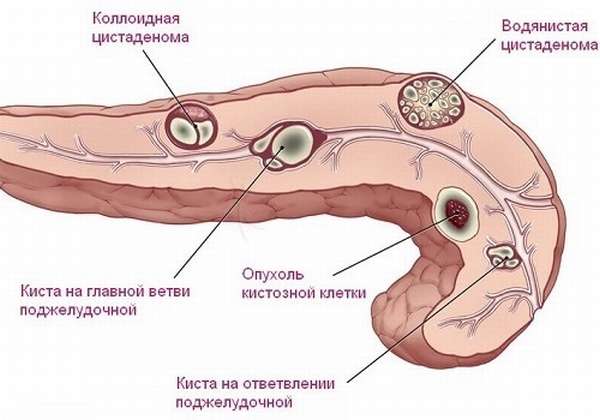 виды цистаденом