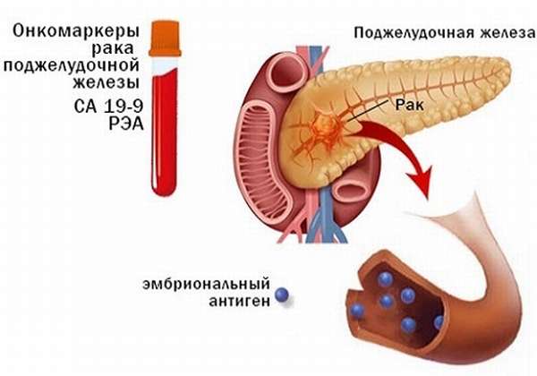Онкомаркеры рака ПЖ