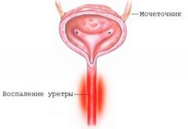 Уретрит 