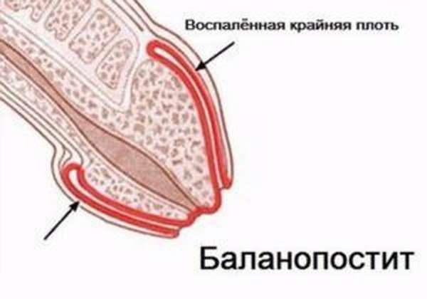 Баланопостит