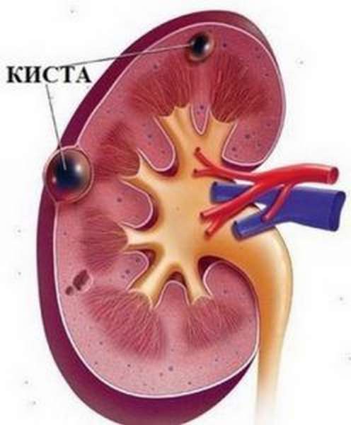 киста почки 