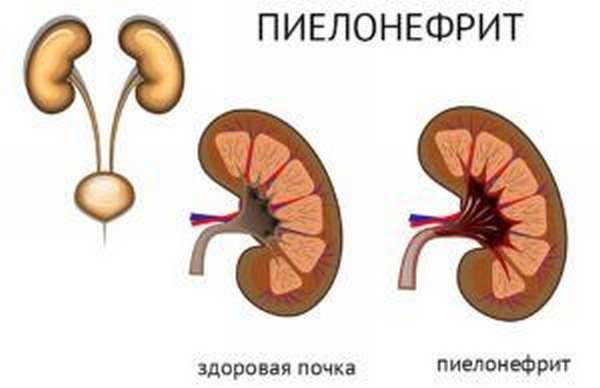 Пиелонефрит