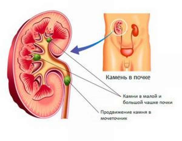 Камни в почках