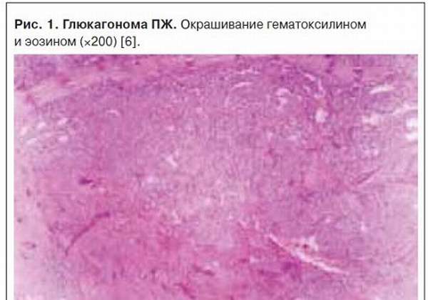 Глюкагонома