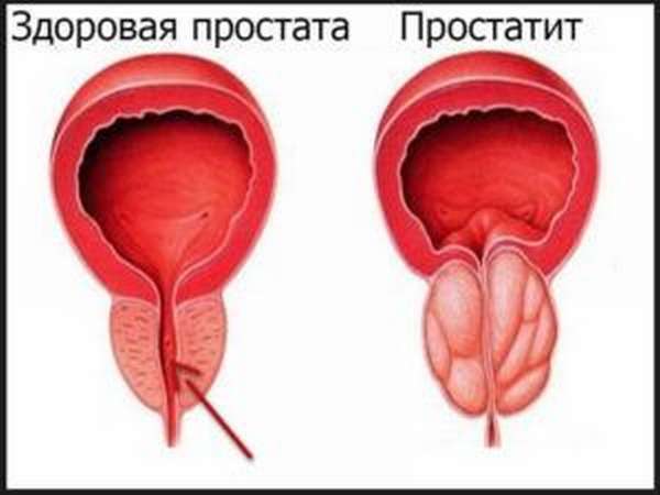 Простатит