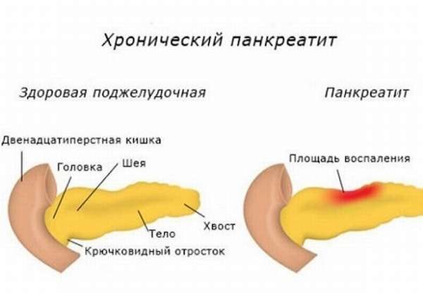Хронический панкреатит