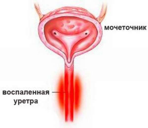 уретрит