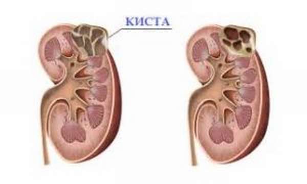 Почечная киста