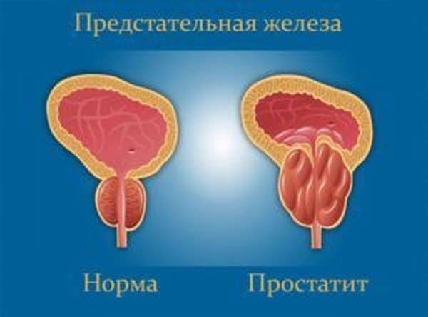 признаки простатита