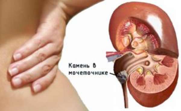 Камни в мочеточнике