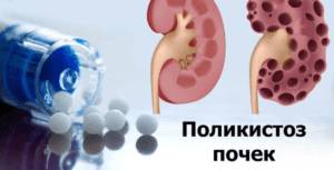 Поликистоз почек