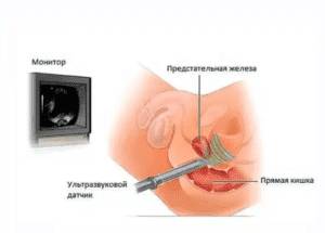 Один из способов УЗИ — через анальное отверстие