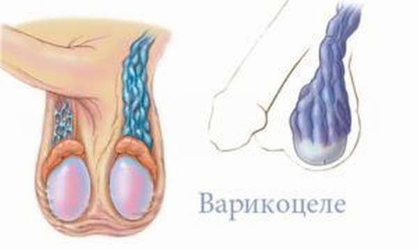 Варикоцеле