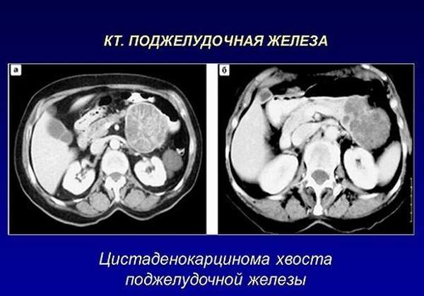 Цистаденокарцинома