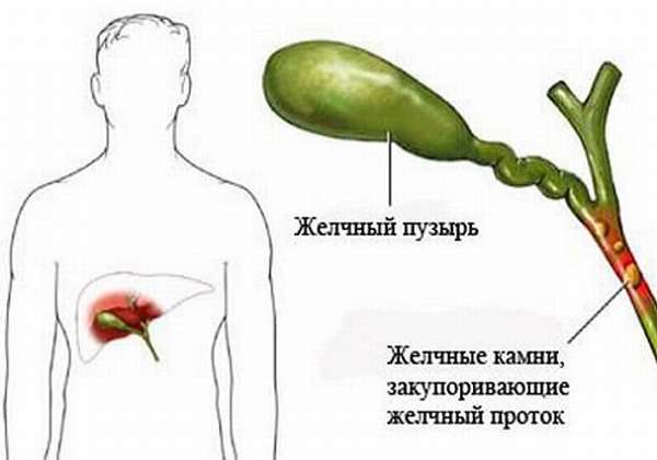 камни в желчном протоке