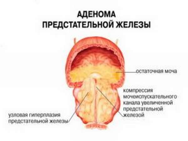 Аденома простаты