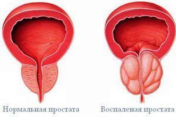 При простатите наблюдается болезненное, прерывистое мочеиспускание