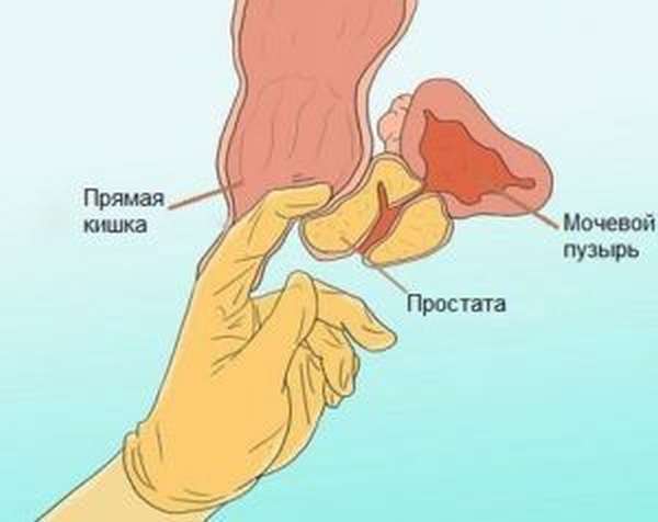 Массаж простаты является хорошей профилактикой простатита