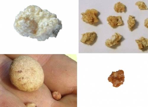 Диета при камнях в почках