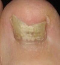 Грибок ногтей