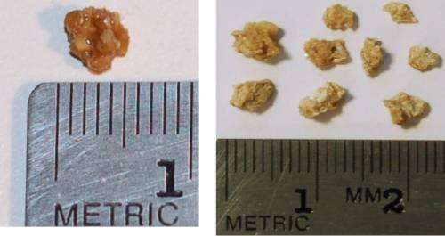 Камни в почках и размеры