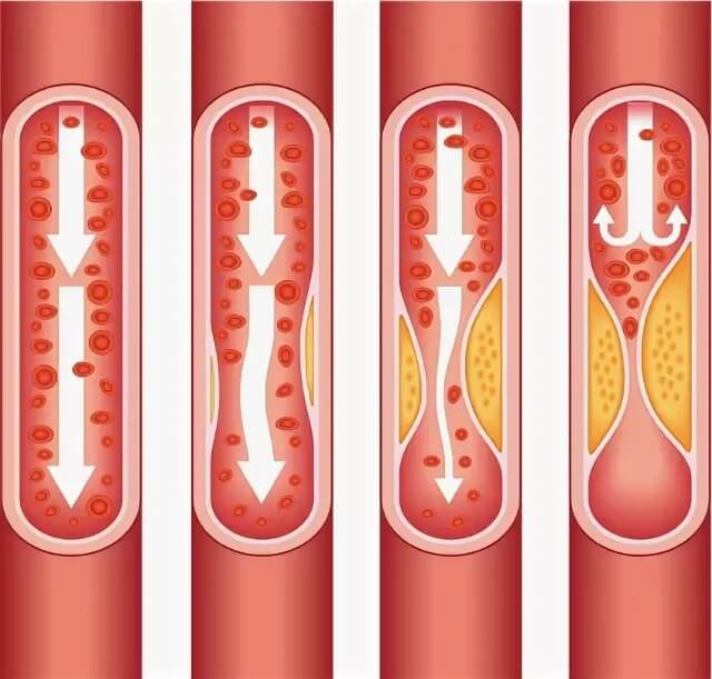 Атеросклероз