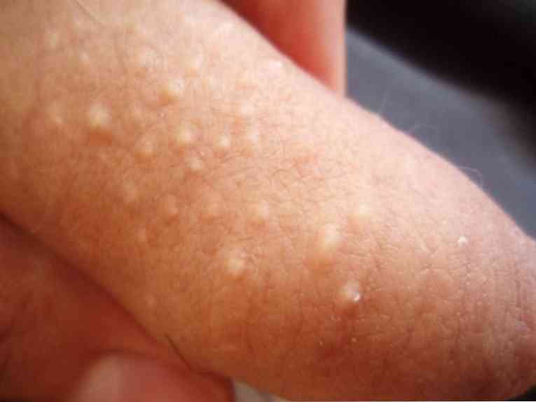 шишка на члене