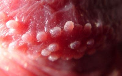 шишки на члене