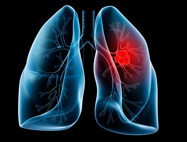 рак легкого